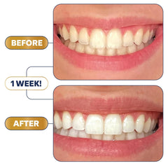 Lumineux Enamel-Safe Teeth Whitening Strips — 21 Treatments | Whiter Teeth Without Sensitivity